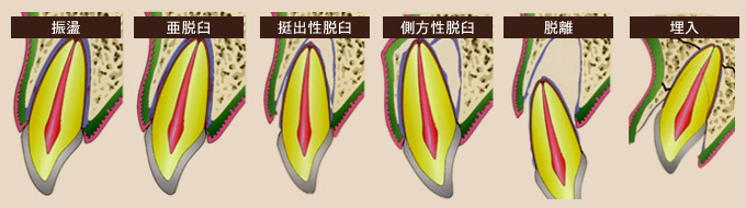 �E�P���̊O��