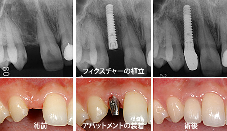 �C���v�����g���Â̗���