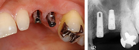 �C���v�����g���Â̗���